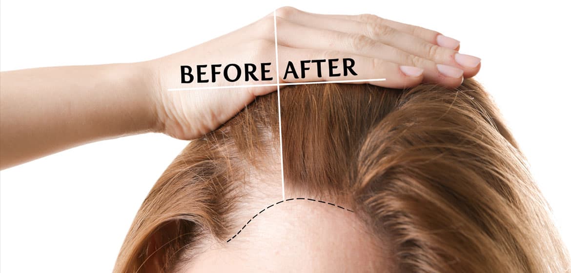 Greffe de cheveux pour femmes