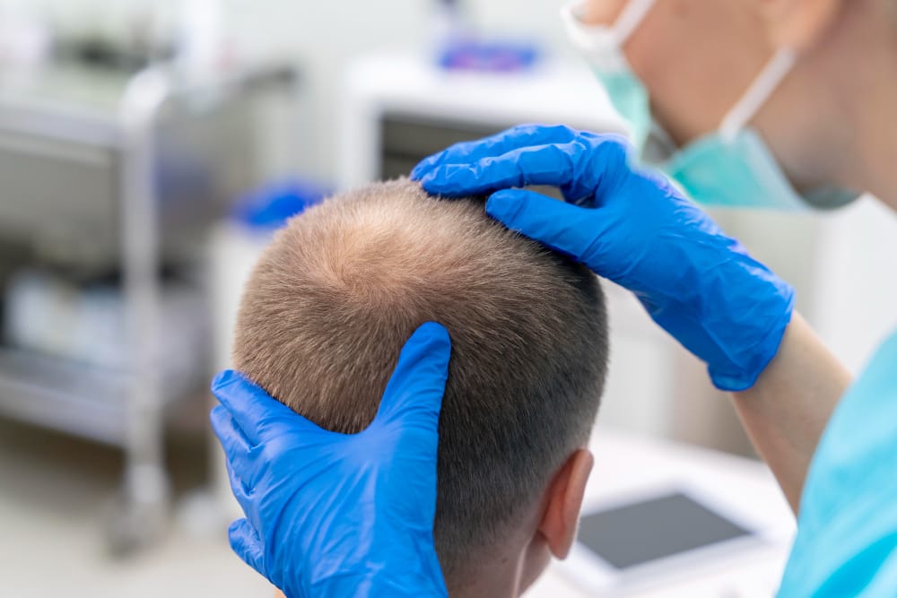 Greffe de cheveux par cellules souches