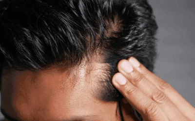 Pourquoi perd-on d’abord ses cheveux au niveau des golfes ? Explication d’un phénomène courant