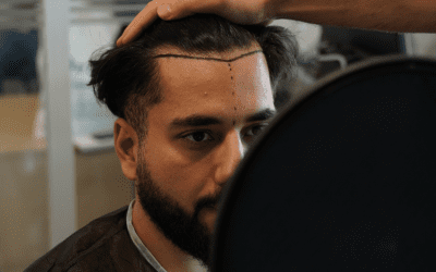 Cicatrisation après une greffe de cheveux : tout ce qu’il faut savoir