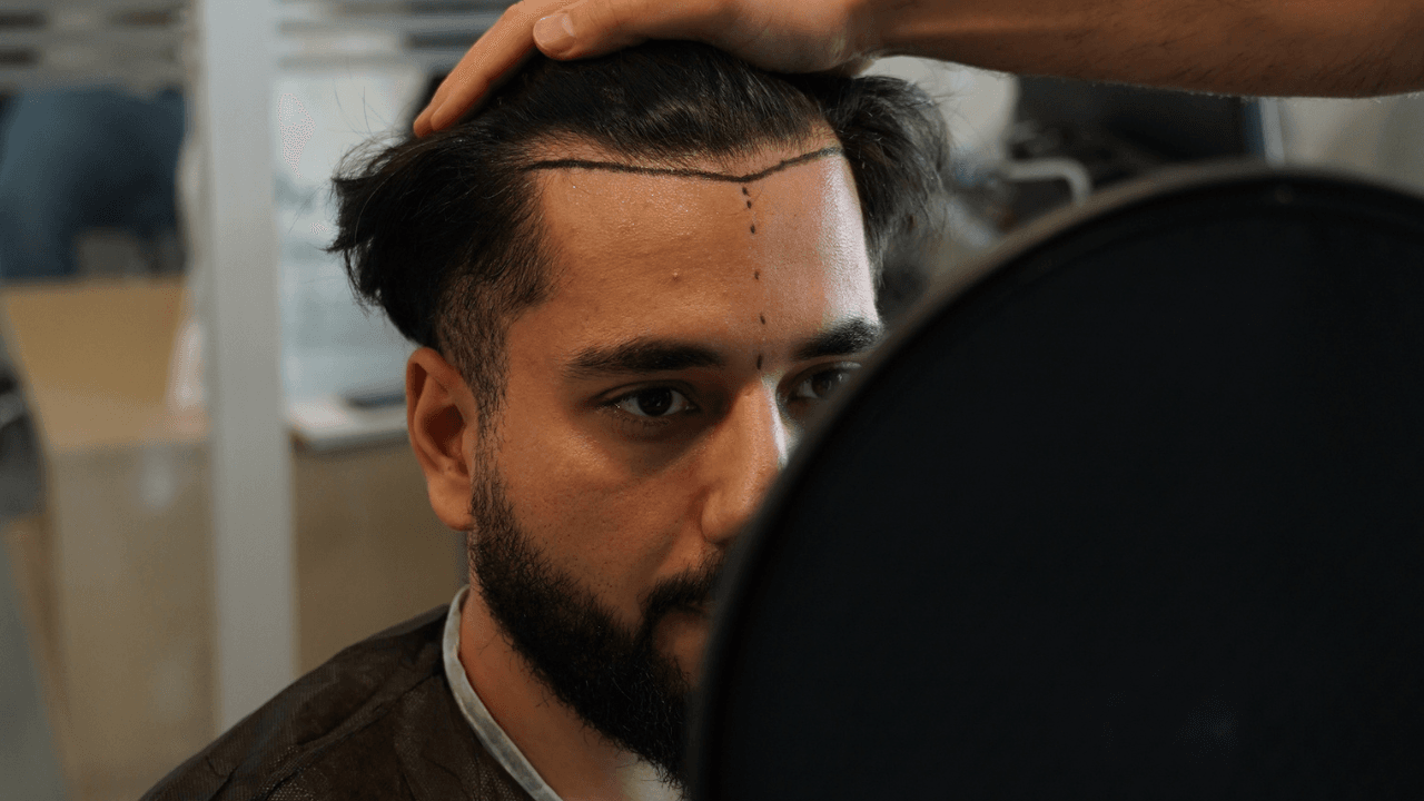 cicatrisation greffe de cheveux