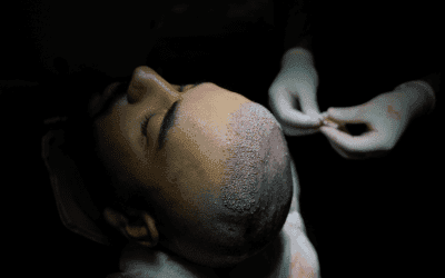 La greffe BHT (Body Hair Transplant) : quand utilise-t-on les poils du corps ? – Bella Hair Clinic