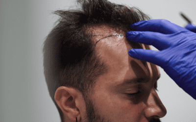 Peut-on faire une greffe capillaire à tout âge ?