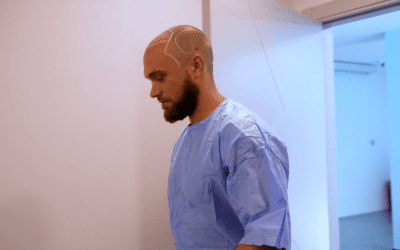 Peut-on faire une deuxième greffe de cheveux ?