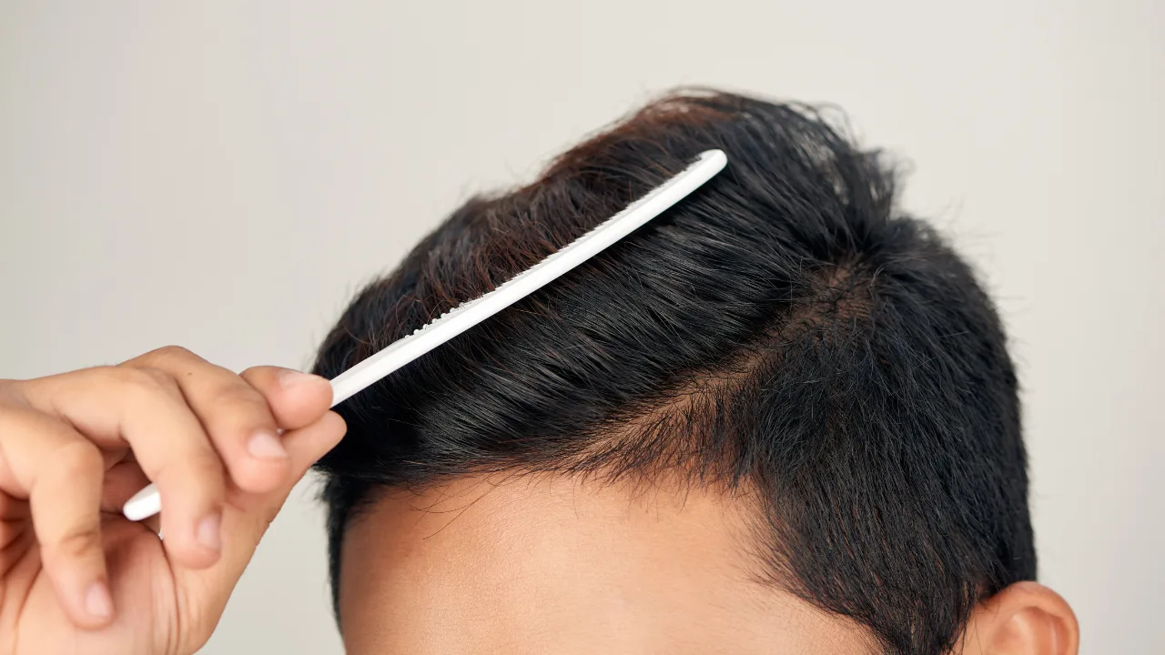cheveux gras chute