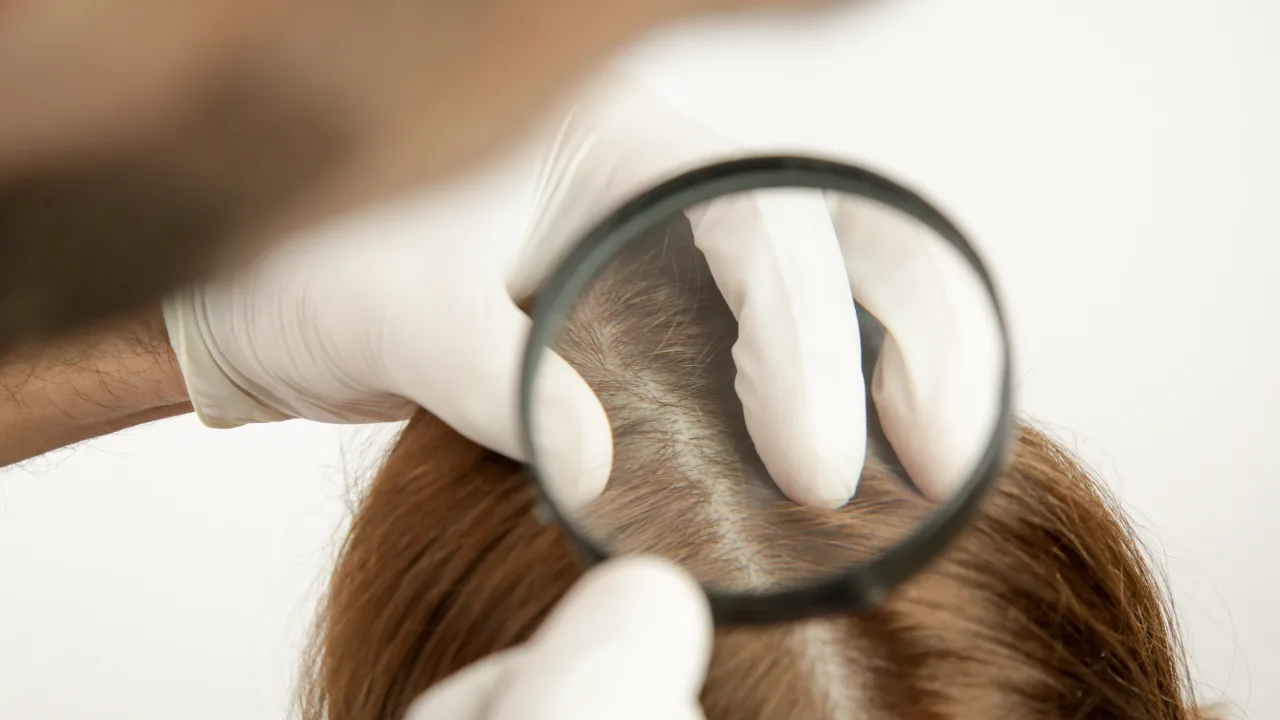 dermatite séborrhéique chute cheveux