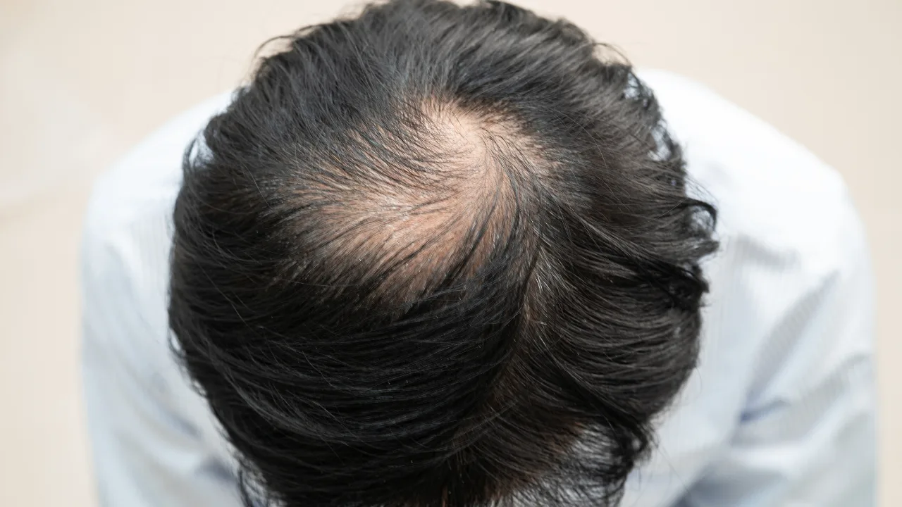 perte cheveux calvitie