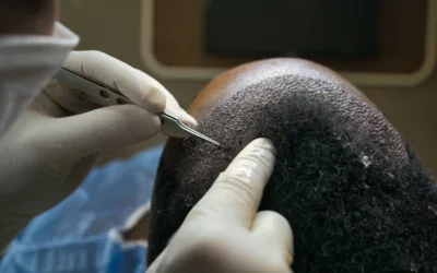Greffe capillaire cheveux afro : ce que les autres cliniques ne disent pas